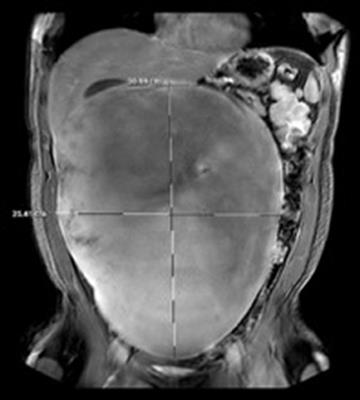 A Large Sporadic Intra-abdominal Desmoid-Type Fibromatosis in a Young Male: A Case Report